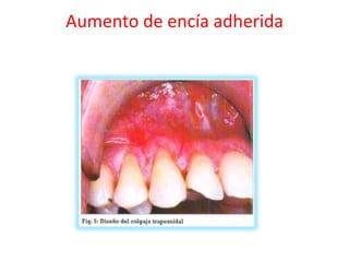 Aumento de encía adherida

 