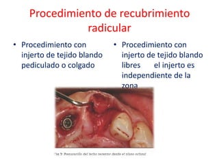 Procedimiento de recubrimiento
radicular
• Procedimiento con
injerto de tejido blando
pediculado o colgado

• Procedimiento con
injerto de tejido blando
libres
el injerto es
independiente de la
zona

 
