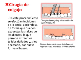 Cirugía de
colgajo
. En este procedimiento
se efectúan incisiones
de la encía, abriéndola,
de forma que queden
expuestas las raíces de
los dientes, lo que
permite extraer los
tejidos dañados y, si es
necesario, dar nueva
forma al hueso.

Cirurgía de colgajo y eliminación del
tejido lesionado

Sutura de la encía para dejarla en su
lugar una vez finalizada la intervención.

 