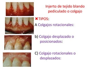 Injerto de tejido blando
pediculado o colgajo

TIPOS:
A Colgajos rotacionales:
b) Colgajo desplazado o
posicionados:
C) Colgajo rotacionales o
desplazados:

 