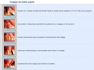 Colgajo de doble papila

 