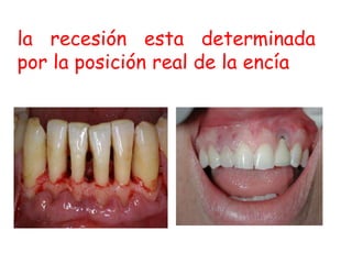 la recesión esta determinada
por la posición real de la encía

 