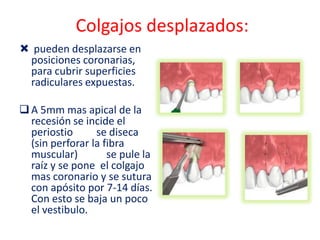 Colgajos desplazados:
 pueden desplazarse en
posiciones coronarias,
para cubrir superficies
radiculares expuestas.
 A 5mm mas apical de la
recesión se incide el
periostio
se diseca
(sin perforar la fibra
muscular)
se pule la
raíz y se pone el colgajo
mas coronario y se sutura
con apósito por 7-14 días.
Con esto se baja un poco
el vestibulo.

 