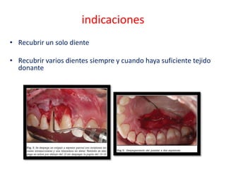 indicaciones
• Recubrir un solo diente

• Recubrir varios dientes siempre y cuando haya suficiente tejido
donante

 