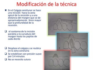 Modificación de la técnica
 En el Colgajo semilunar se hace
una incisión hacia la zona
apical de la recesión y a una
distancia del margen que se de
aproximadamente 3mm mayor
que la profundidad de la
recesión.
 el contorno de la incisión
paralela a la curvatura del
margen hasta las papilas de
cada diente

 Desplaza el colgajo y se reubica
en la zona coronaria
 Se estabilizan con presión suave
por 3.4 minutos
 No se necesita sutura

 