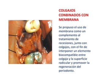 COLGAJOS
CONBINADOS CON
MEMBRANA
Se propuso el uso de
membrana como un
complemento al
tratamiento de
recesiones, junto con
colgajos, con el fin de
interponer un elemento
biocompatible entre
colgajo y la superficie
radicular y promover la
regeneración del
periodonto.

 