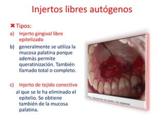 Injertos libres autógenos
Tipos:
a) Injerto gingival libre
epitelizado
b) generalmente se utiliza la
mucosa palatina porque
además permite
queratinización. También
llamado total o completo.
c) Injerto de tejido conectivo
al que se le ha eliminado el
epitelio. Se obtiene
también de la mucosa
palatina.

 