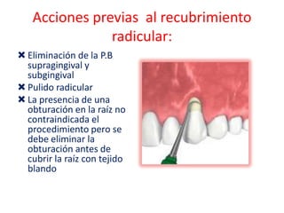 Acciones previas al recubrimiento
radicular:
 Eliminación de la P.B
supragingival y
subgingival
 Pulido radicular
 La presencia de una
obturación en la raíz no
contraindicada el
procedimiento pero se
debe eliminar la
obturación antes de
cubrir la raíz con tejido
blando

 