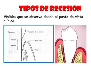 TIPOS DE RECESION
Visible: que se observa desde el punto de vista
clínico.

 