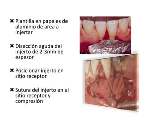  Plantilla en papeles de
aluminio de area a
injertar
 Disección aguda del
injerto de 2-3mm de
espesor
 Posicionar injerto en
sitio receptor
 Sutura del injerto en el
sitio receptor y
compresión

 