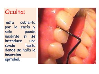 Oculta:
esta
cubierta
por la encía y
solo
puede
medirse si se
introduce
una
sonda
hasta
donde se halla la
inserción
epitelial.

 