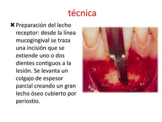 técnica
Preparación del lecho
receptor: desde la línea
mucogingival se traza
una incisión que se
extiende uno o dos
dientes contiguos a la
lesión. Se levanta un
colgajo de espesor
parcial creando un gran
lecho óseo cubierto por
periostio.

 