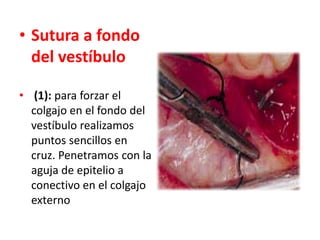 • Sutura a fondo
del vestíbulo
• (1): para forzar el
colgajo en el fondo del
vestíbulo realizamos
puntos sencillos en
cruz. Penetramos con la
aguja de epitelio a
conectivo en el colgajo
externo

 