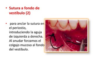 • Sutura a fondo de
vestíbulo (2)
• para anclar la sutura en
el periostio,
introduciendo la aguja
de izquierda a derecha.
Al anudar forzamos el
colgajo mucoso al fondo
del vestíbulo.

 