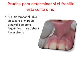 Prueba para determinar si el frenillo
esta corto o no:
• Si al traccionar el labio
se separa el margen
gingival o se pone
isquémico
se deberá
hacer cirugía

 