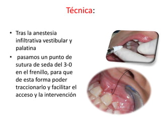 Técnica:
• Tras la anestesia
infiltrativa vestibular y
palatina
• pasamos un punto de
sutura de seda del 3-0
en el frenillo, para que
de esta forma poder
traccionarlo y facilitar el
acceso y la intervención

 