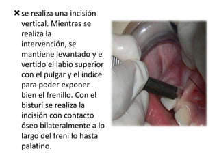 se realiza una incisión
vertical. Mientras se
realiza la
intervención, se
mantiene levantado y e
vertido el labio superior
con el pulgar y el índice
para poder exponer
bien el frenillo. Con el
bisturí se realiza la
incisión con contacto
óseo bilateralmente a lo
largo del frenillo hasta
palatino.

 