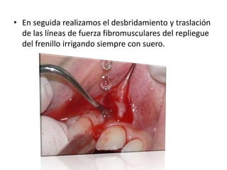 • En seguida realizamos el desbridamiento y traslación
de las líneas de fuerza fibromusculares del repliegue
del frenillo irrigando siempre con suero.

 