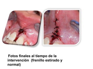 Fotos finales al tiempo de la
intervención (frenillo estirado y
normal)

 