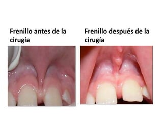 Frenillo antes de la
cirugía

Frenillo después de la
cirugía

 