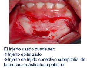 El injerto usado puede ser:
Injerto epitelizado
Injerto de tejido conectivo subepitelial de
la mucosa masticatoria palatina.

 
