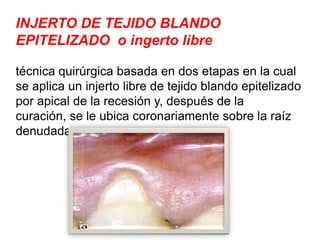 INJERTO DE TEJIDO BLANDO
EPITELIZADO o ingerto libre
técnica quirúrgica basada en dos etapas en la cual
se aplica un injerto libre de tejido blando epitelizado
por apical de la recesión y, después de la
curación, se le ubica coronariamente sobre la raíz
denudada,

 