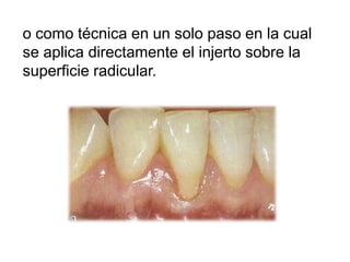 o como técnica en un solo paso en la cual
se aplica directamente el injerto sobre la
superficie radicular.

 