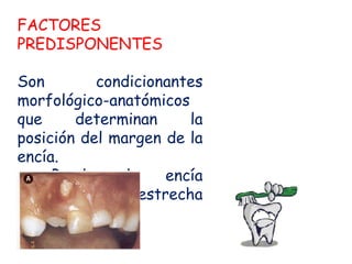 FACTORES
PREDISPONENTES
Son
condicionantes
morfológico-anatómicos
que
determinan
la
posición del margen de la
encía.
Banda
de
encía
adherida
estrecha

 