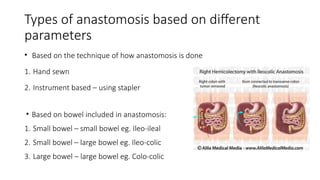 Types of anastomosis based on different
parameters
• Based on the technique of how anastomosis is done
1. Hand sewn
2. Instrument based – using stapler
• Based on bowel included in anastomosis:
1. Small bowel – small bowel eg. Ileo-ileal
2. Small bowel – large bowel eg. Ileo-colic
3. Large bowel – large bowel eg. Colo-colic
 
