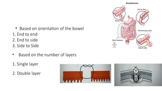 • Based on orientation of the bowel
1. End to end
2. End to side
3. Side to Side
• Based on the number of layers
1. Single layer
2. Double layer
 