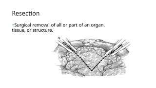Resection
•Surgical removal of all or part of an organ,
tissue, or structure.
 