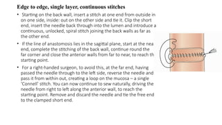 Edge to edge, single layer, continuous stitches
• Starting on the back wall, insert a stitch at one end from outside in
on one side, inside: out on the other side and tie it. Clip the short
end, insert the needle back through into the lumen and introduce a
continuous, unlocked, spiral stitch joining the back walls as far as
the other end.
• If the line of anastomosis lies in the sagittal plane, start at the near
end, complete the stitching of the back wall, continue round the
far corner and close the anterior walls from far to near, to reach the
starting point.
• For a right-handed surgeon, to avoid this, at the far end, having
passed the needle through to the left side, reverse the needle and
pass it from within out, creating a loop on the mucosa – a single
‘Connell’ stitch. You can now continue to sew naturally, driving the
needle from right to left along the anterior wall, to reach the
starting point. Remove and discard the needle and tie the free end
to the clamped short end.
 