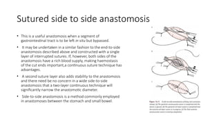 Sutured side to side anastomosis
• This is a useful anastomosis when a segment of
gastrointestinal tract is to be left in situ but bypassed.
• It may be undertaken in a similar fashion to the end-to-side
anastomosis described above and constructed with a single
layer of interrupted sutures. If, however, both sides of the
anastomosis have a rich blood supply, making haemostasis
of the cut ends important,a continuous suture technique has
advantages.
• A second suture layer also adds stability to the anastomosis
and there need be no concern in a wide side-to-side
anastomosis that a two-layer continuous technique will
significantly narrow the anastomotic diameter.
• Side-to-side anastomosis is a method commonly employed
in anastomoses between the stomach and small bowel.
 