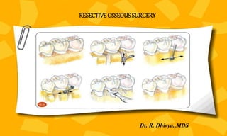 RESECTIVE OSSEOUS SURGERY
Dr. R. Dhivya.,MDS
 
