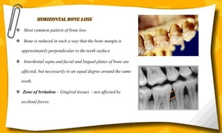 HORIZONTAL BONE LOSS
 Most common pattern of bone loss
 Bone is reduced in such a way that the bone margin is
approximately perpendicular to the teeth surface
 Interdental septa and facial and lingual plates of bone are
affected, but necessarily to an equal degree around the same
tooth.
 Zone of Irritation – Gingival tissues - not affected by
occlusal forces.
14
 