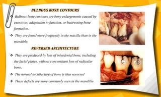 BULBOUS BONE CONTOURS
 Bulbous bone contours are bony enlargements caused by
exostoses, adaptation to function, or buttressing bone
formation.
 They are found more frequently in the maxilla than in the
mandible.
REVERSED ARCHITECTURE
 They are produced by loss of interdental bone, including
the facial plates, without concomitant loss of radicular
bone.
 The normal architecture of bone is thus reversed
 These defects are more commonly seen in the mandible
 