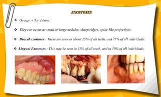 EXOSTOSES
 Overgrowths of bone
 They can occur as small or large nodules, sharp ridges, spike-like projections.
 Buccal exostoses : These are seen in about 25% of all teeth, and 77% of all individuals.
 Lingual Exostoses : This may be seen in 11% of all teeth, and in 50% of all individuals.
 