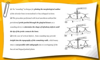  The "sounding" technique for plotting the morphological outline
of the alveolar bone in mesiodistal or buccolingual sections.
 This procedure performed with local anesthesia utilized the
periodontal probe pushed through the gingival tissues as a
sounding device to determine the shape of infrabony defects until
the tip of the probe contacts the bone.
 In the case of vertical defects , bone sounding may provide
insight into the topography of the remaining walls, which many
times is not possible with radiographs due to overlapping of the
buccal and lingual/palatal plates.
 