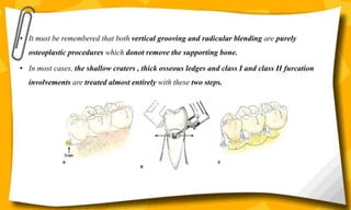 • It must be remembered that both vertical grooving and radicular blending are purely
osteoplastic procedures which donot remove the supporting bone.
• In most cases, the shallow craters , thick osseous ledges and class I and class II furcation
involvements are treated almost entirely with these two steps.
 