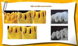 Before and after osseous resection
 