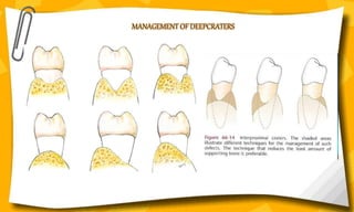 MANAGEMENT OF DEEPCRATERS
24
 