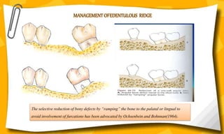 MANAGEMENT OFEDENTULOUS RIDGE
The selective reduction of bony defects by “ramping” the bone to the palatal or lingual to
avoid involvement of furcations has been advocated by Ochsenbein and Bohnnan(1964).
 