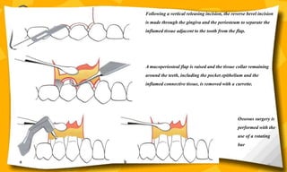 Following a vertical releasing incision, the reverse bevel incision
is made through the gingiva and the periosteum to separate the
inflamed tissue adjacent to the tooth from the flap.
A mucoperiosteal flap is raised and the tissue collar remaining
around the teeth, including the pocket epithelium and the
inflamed connective tissue, is removed with a currette.
Osseous surgery is
performed with the
use of a rotating
bur
60
 