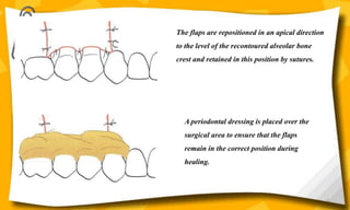 The flaps are repositioned in an apical direction
to the level of the recontoured alveolar bone
crest and retained in this position by sutures.
A periodontal dressing is placed over the
surgical area to ensure that the flaps
remain in the correct position during
healing.
61
 