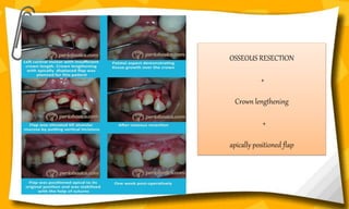 OSSEOUS RESECTION
+
Crown lengthening
+
apically positioned flap
 