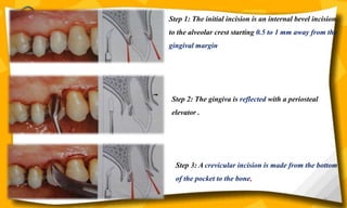 66
Step 1: The initial incision is an internal bevel incision
to the alveolar crest starting 0.5 to 1 mm away from the
gingival margin
Step 2: The gingiva is reflected with a periosteal
elevator .
Step 3: A crevicular incision is made from the bottom
of the pocket to the bone,
 