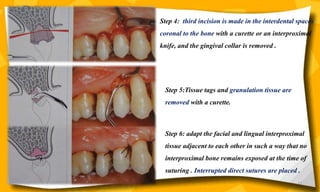 67
Step 4: third incision is made in the interdental spaces
coronal to the bone with a curette or an interproximal
knife, and the gingival collar is removed .
Step 5:Tissue tags and granulation tissue are
removed with a curette.
Step 6: adapt the facial and lingual interproximal
tissue adjacent to each other in such a way that no
interproximal bone remains exposed at the time of
suturing . Interrupted direct sutures are placed .
 