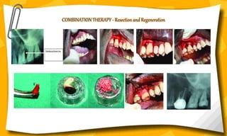 COMBINATION THERAPY - Resection and Regeneration
 