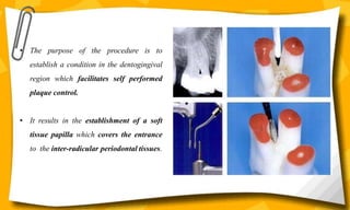 Resective osseous surgery