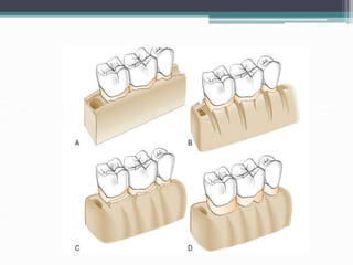 Flap management
• Adapt over the alveolar process
• Thinning of flap
• Esthetic areas- papilla preservation techniques
• P...